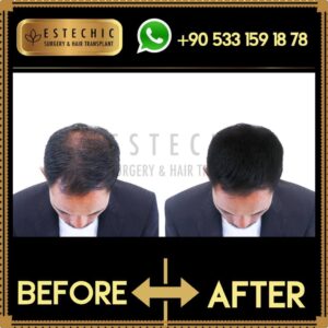 Before-After-Estechic00004