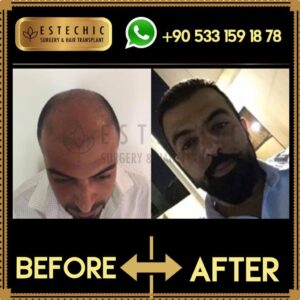 Before-After-Estechic00007