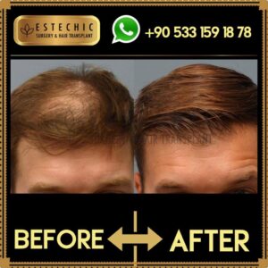 Before-After-Estechic00009