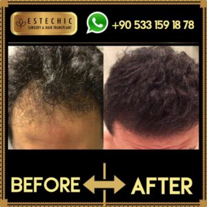 Before-After-Estechic00010