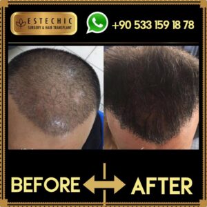 Before-After-Estechic00012