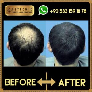 Before-After-Estechic00014