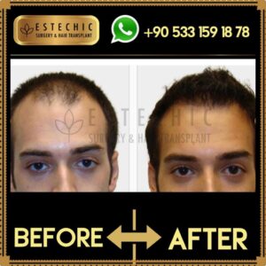Before-After-Estechic00016