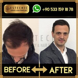 Before-After-Estechic00020
