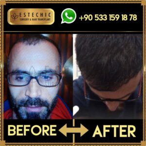 Before-After-Estechic00024