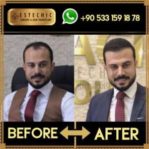 Before-After-Estechic00025