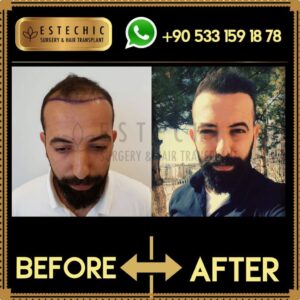 Before-After-Estechic00026