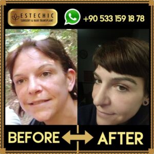 ESTECHIC-Before-after-2022-03-01